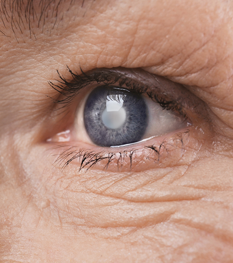 Close up of an eye with a cloudy white pupil