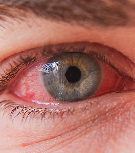 Close up of a very bloodshot eye