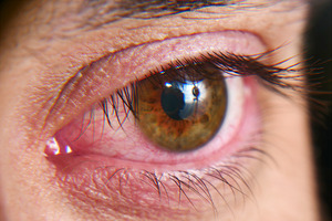 Close-up of woman with dry eye syndrome